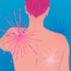 Fibromyalgia