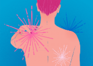 Fibromyalgia