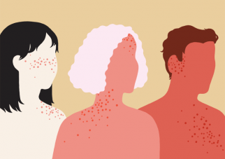 Healthline Psoriasis