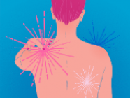 Fibromyalgia